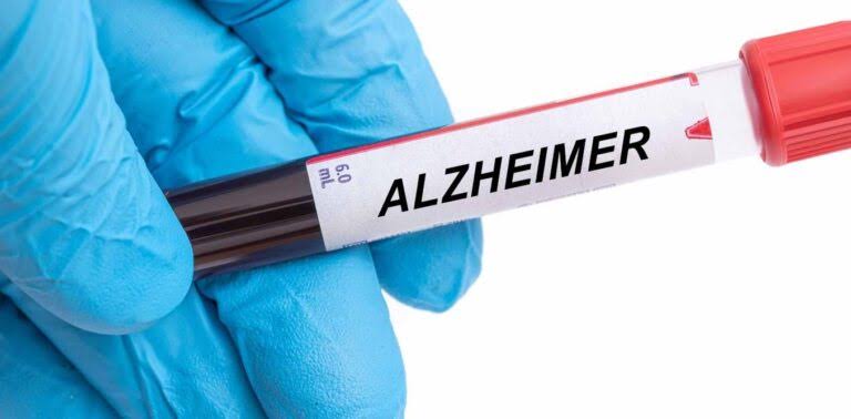 Avance clave: un análisis de sangre mejora el diagnóstico del Alzheimer
